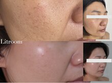リトルーム(Litroom: from Seoul)/凸凹肌の改善ケア