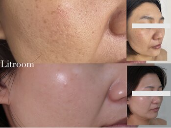 リトルーム(Litroom: from Seoul)/凸凹肌の改善ケア