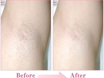 エンドモウ(END MOU)/美肌効果も期待大の脇脱毛◎