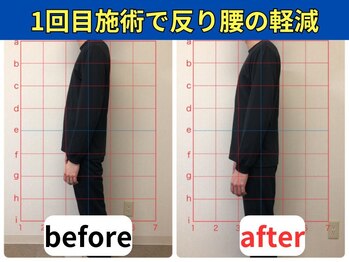 リポール 目黒(Re pol)/BeforeAfter 骨盤矯正・姿勢矯正