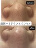超美肌★最高峰毛穴洗浄ハイドラ全顔＆ヒト幹細胞培養液導！通常¥12600 75分