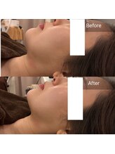 ヨロン(YORON)/レモンボトル溶解