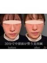 チョコバリ 錦糸町店(chocobari)/小顔×リフトアップ(美容鍼)20代