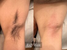 アルム(Arum)/メンズわきWax