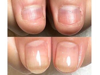 ヴァーチュ(Virtue)の写真/もう隠さない！深爪矯正で、悩み続けた自爪のコンプレックス解消★綺麗な指先を手に入れるための美爪育成！