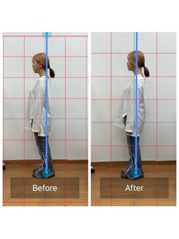 朱雀整骨院/姿勢矯正before after