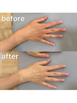 ハンドケアビフォーアフター