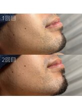 カナウ(KANAU)/ヒゲ脱毛（20代前半男性）