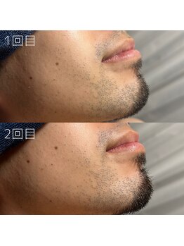 カナウ(KANAU)/ヒゲ脱毛（20代前半男性）