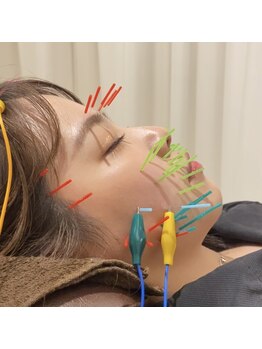 恵比寿すこやか鍼灸整骨院/リフトアップ特化型美容鍼