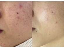 サロン ヌーク(salon Nook)/黒ずみケア