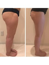 ビネージュ/痩身