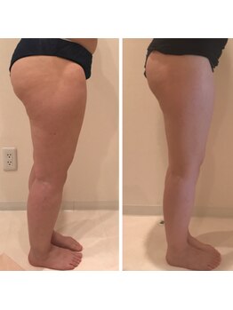 ビネージュ/痩身