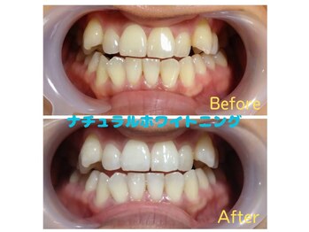 キラリン(Kirarin)