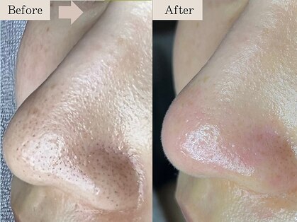 ティーツリー(Tea Tree)の写真