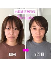小顔矯正サロン セラフィ/3回目は整ってリフトUP小顔に♪