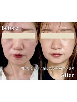 ホウレイ線・たるみ改善！予防ケア