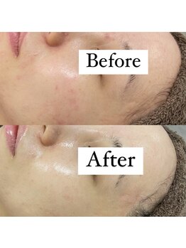 カルディエ(Cardie)/肌質改善　ビフォーアフター