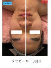 ユフラ(Juhla)/ララピール