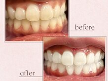 ルアナシンフォニア エクシア 恵比寿店(Luana-Sinfonia)/ホワイトニングビフォーアフター