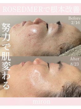 ミロン(miron)/努力で肌変わる