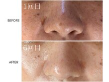 ミチル(mi-chill)/長年の黒ずみを撃退！