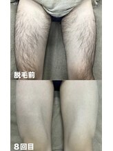 ビューティーサロンレモン(Lemon)/もも脱毛