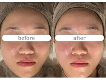 リスタ(RSTA)/【BEFORE/AFTER】