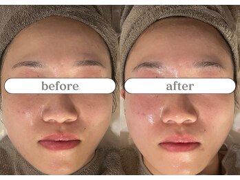 リスタ(RSTA)/【BEFORE/AFTER】