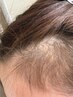 40代・50代の抜け毛・分け目が気になる方へ　頭皮改善コース　¥10,000