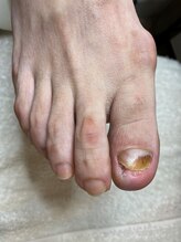 フットメンテ 巻き爪矯正センター 南浦和/陥入爪　施術後