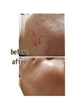 エクラ/ハーブピーリングの効果