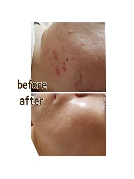 エクラ/ハーブピーリングの効果