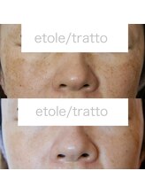 エトル(etole)/40代お客様症例写真