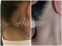 エルール トータルビューティ(Aileure total beauty)/脱毛