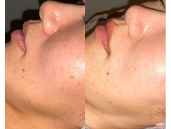 ル シーニュ/ニキビケア