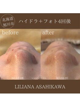 リリアーナ アサヒカワ(LILIANA ASAHIKAWA)/ハイドラ毛穴洗浄＋光フォト