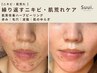【ニキビ・肌荒れ】繰り返す肌悩みに◎肌質改善ハーブピーリング120分