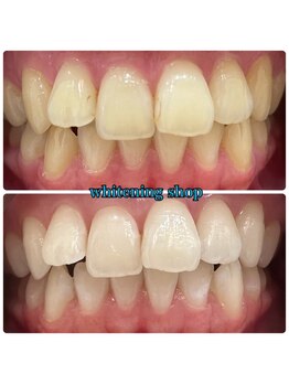 ホワイトニングショップ 八重瀬店/【ビフォーアフター】美白