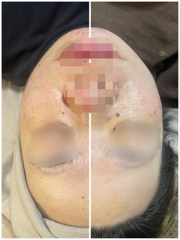 ニコリ(Nicori)/ハーブピーリング