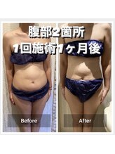 ラベージャ(La Bella)/脂肪冷却