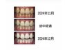 歯科提携ホワイトニング45分照射×3回券