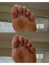 おん/前足部のタコ