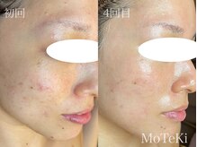 モテキ 表参道店(MoTeKi)/症例Befor/Afterくすみ/トーンUP