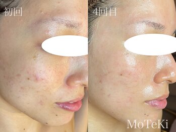 モテキ 表参道店(MoTeKi)/症例Befor/Afterくすみ/トーンUP