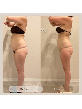 サンスエイジ(Sans age)/スリムカッター 2部位