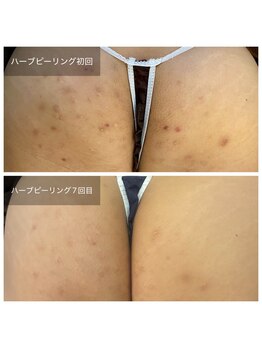 ビビ(VIVI)/お尻ニキビケアハーブピーリング