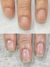 リファーレ(RIFARE)/深爪矯正Before→After