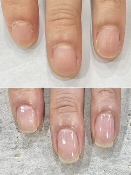 深爪矯正Before→After