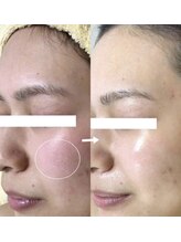 ラボーテエサンテ バイ ティアラ(la beaute et sante by Tiara)/赤み改善、敏感肌の方も◎